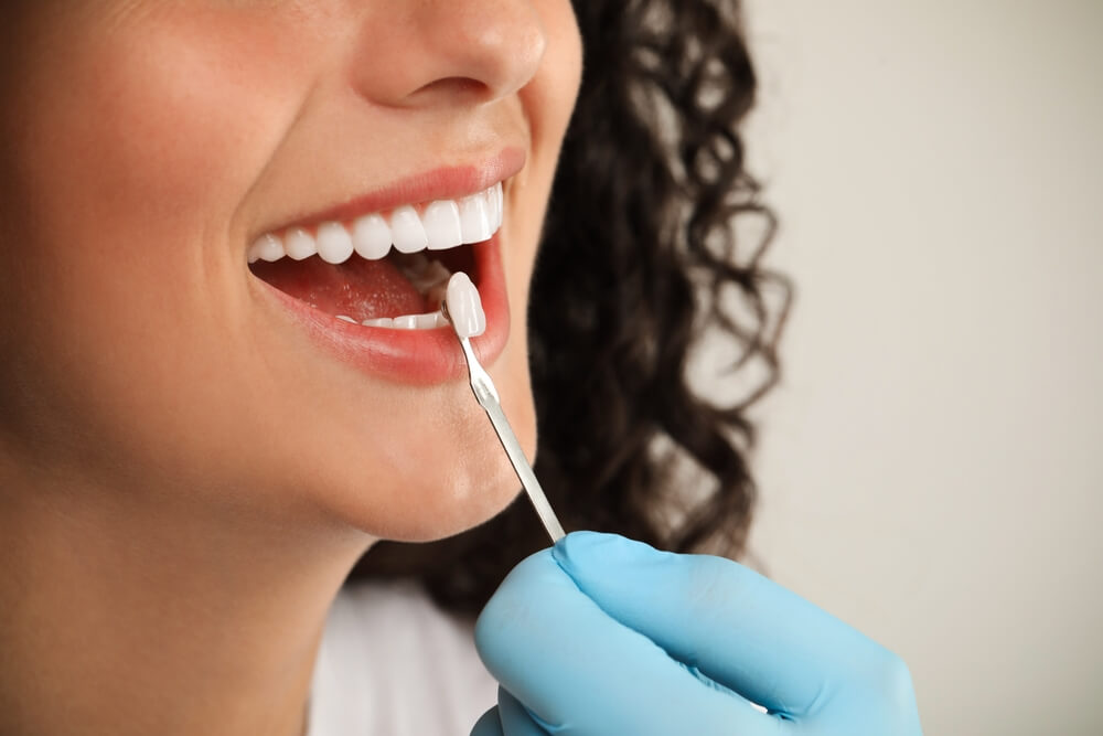 Dental Crowns Vs Veneers