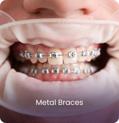 Dental Crown