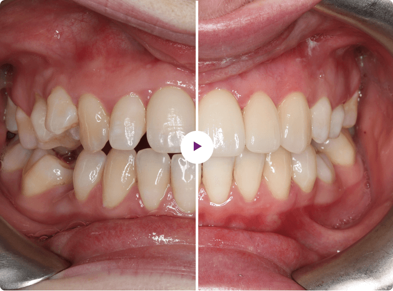 Dental Veneers (1)
