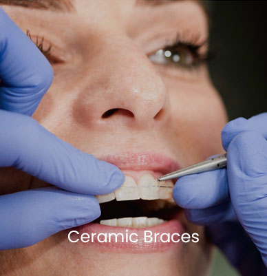 Ceramic Braces 1
