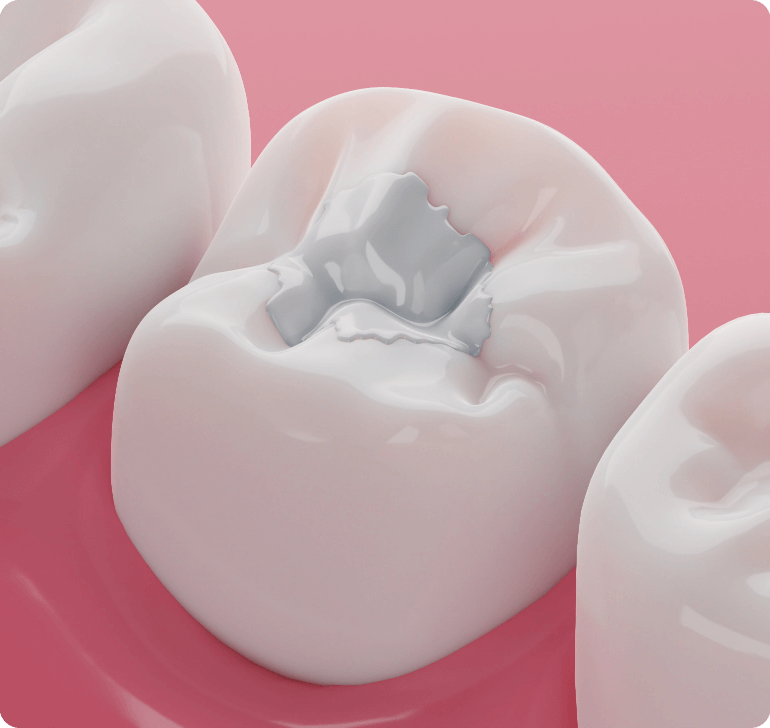 All On 4® Implants003