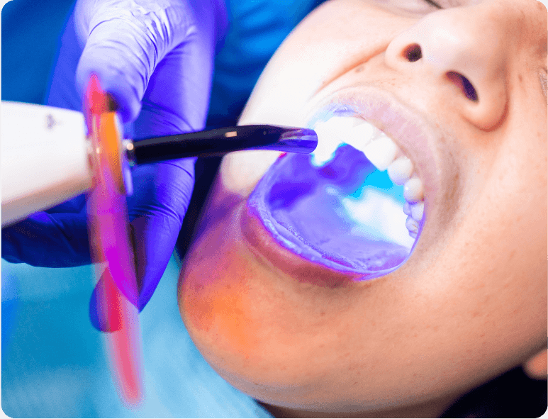 Tooth Fillings 194