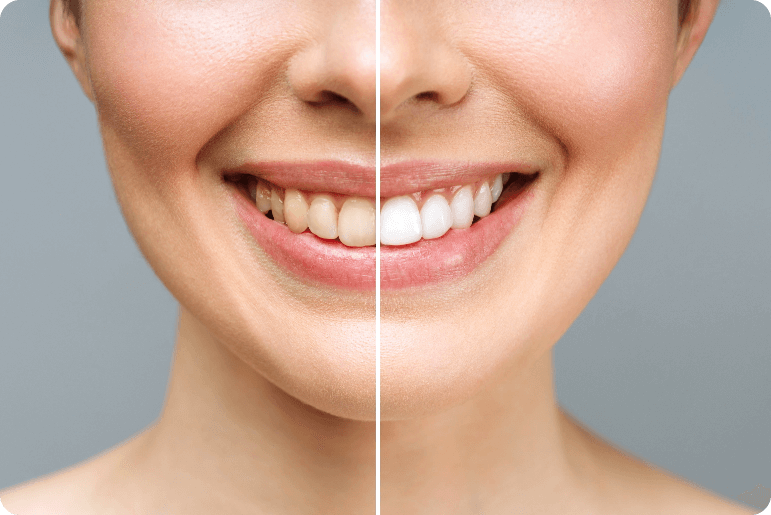 Woman Teeth Before After Whitening White Background Dental Clinic Patient Image Symbolizes (1)