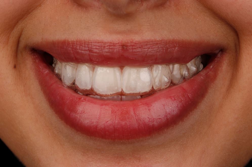 Close Up Of Teeth With Invisalign Clear Aligners For Discreet Orthodontic Treatment